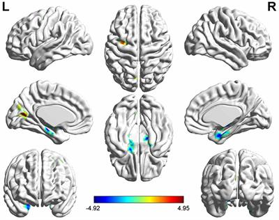 Aberrant Brain Function in Active-Stage Ulcerative Colitis Patients: A Resting-State Functional MRI Study